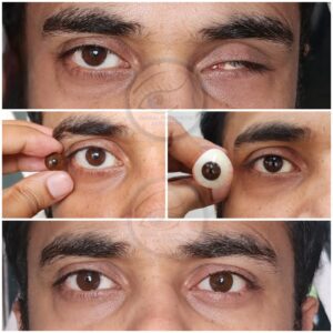 Case of Pthisis Bulbi ( Shrunken Eye)